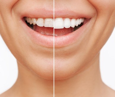 Before and after of cosmetic dentistry