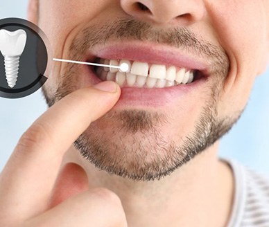 a man pointing to his dental implant