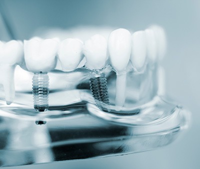 Whiteish 3D rendering of a single dental implant in a transparent lower jaw