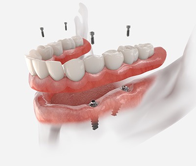 Profile view of an implant bridge in a model lower jaw with a gray background