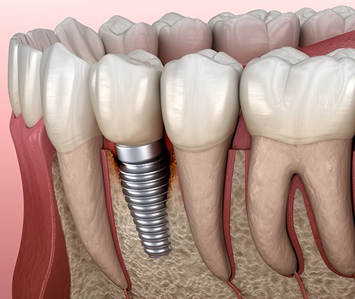 Illustration of peri-implantitis infection